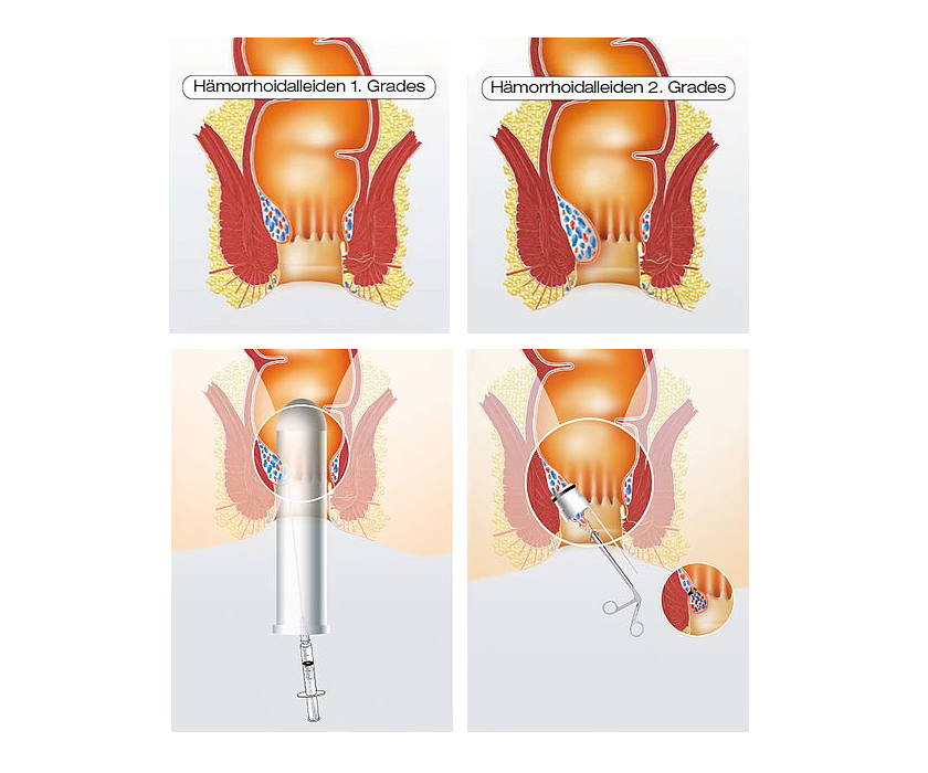 Konservative Behandlungsmethoden bei Hämorrhoiden in Anfangsstadien