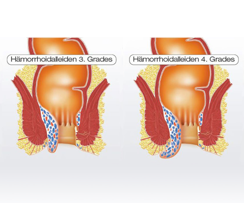 Hämorrhoidalleiden in fortgeschrittenen Stadien 