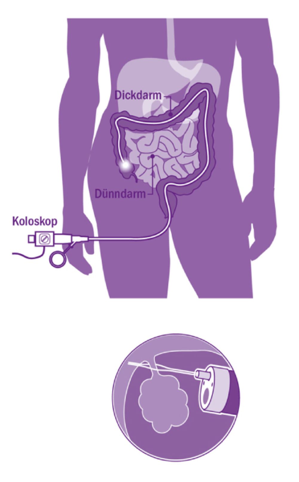 Endoskopische Kontrolle der Dick- und Dünndarmdarmschleimhaut
