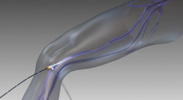 Endovenöses Katheterverfahren am Bein