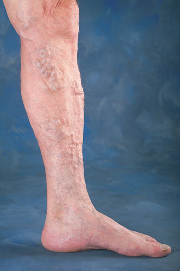Bein mit knotig-erweiterten Blutgefäßen
